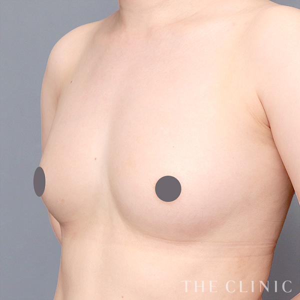 ボリュームアップのコンデンスリッチ豊胸（27歳女性）の術前写真