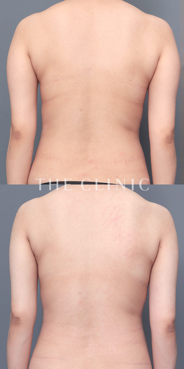 二の腕のベイザー脂肪吸引（29歳女性）の術前・術後写真