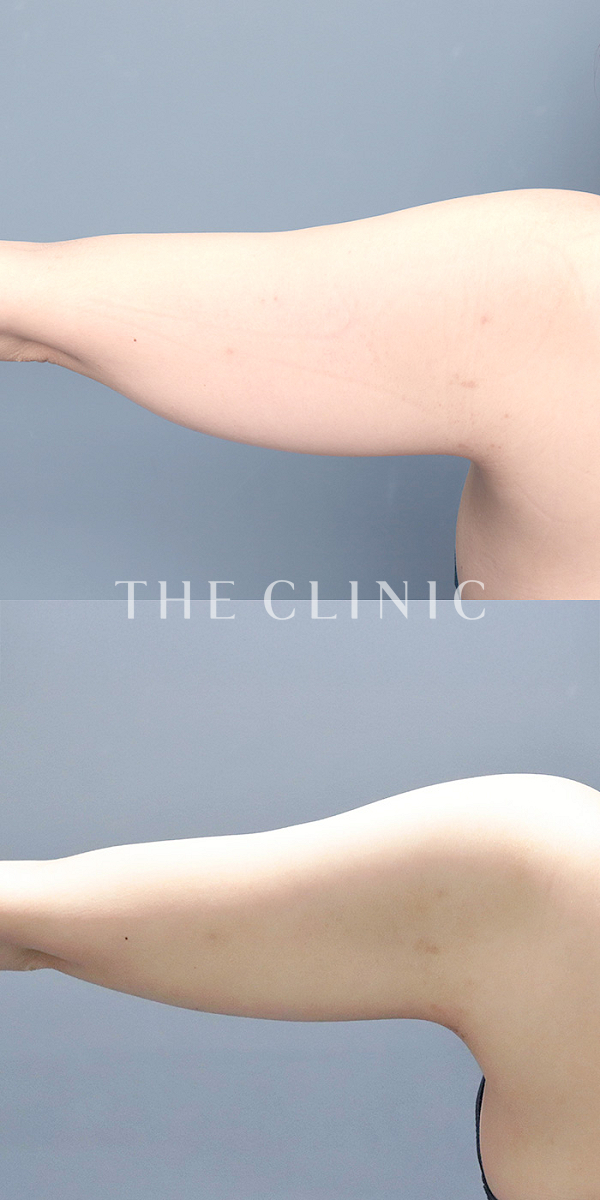 二の腕のベイザー脂肪吸引（30歳女性）の術前・術後写真