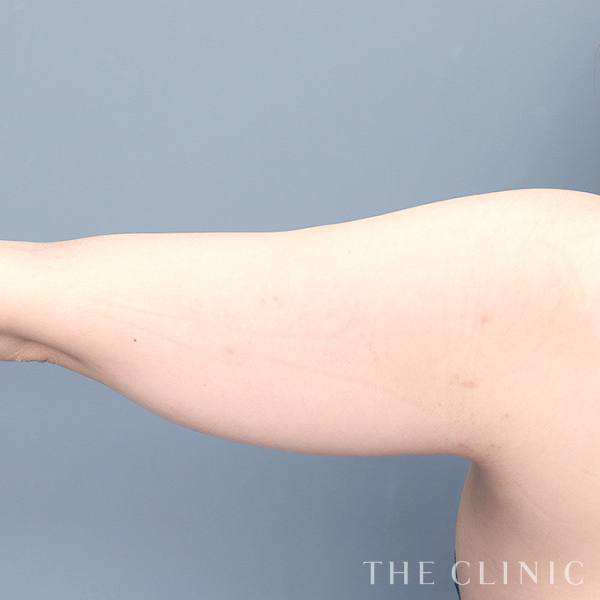 二の腕のベイザー脂肪吸引（30歳女性）の術前写真