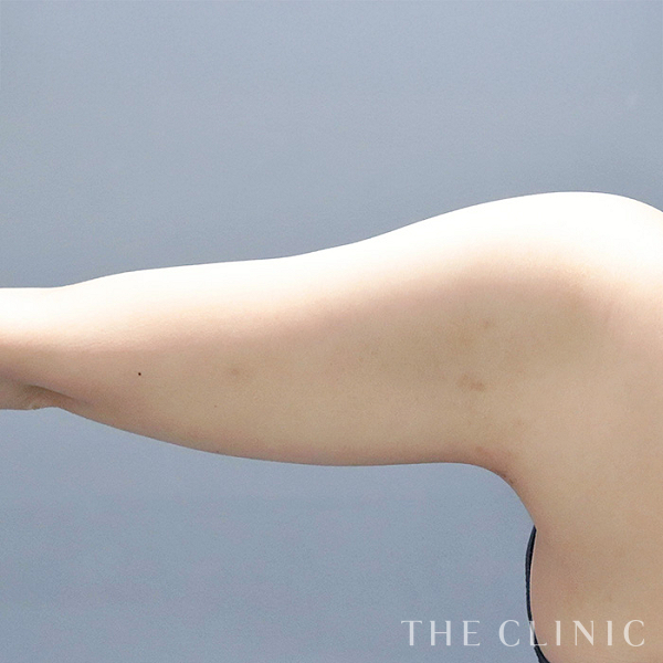 二の腕のベイザー脂肪吸引（30歳女性）の術後写真