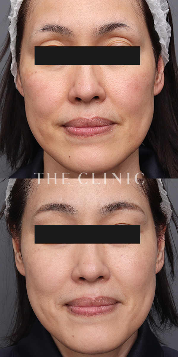 目の上のくぼみのマイクロCRF注入(顔の脂肪注入)（49歳女性）の術前・術後写真