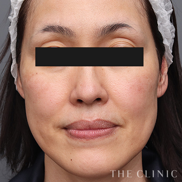目の上のくぼみのマイクロCRF注入(顔の脂肪注入)（49歳女性）の術前写真