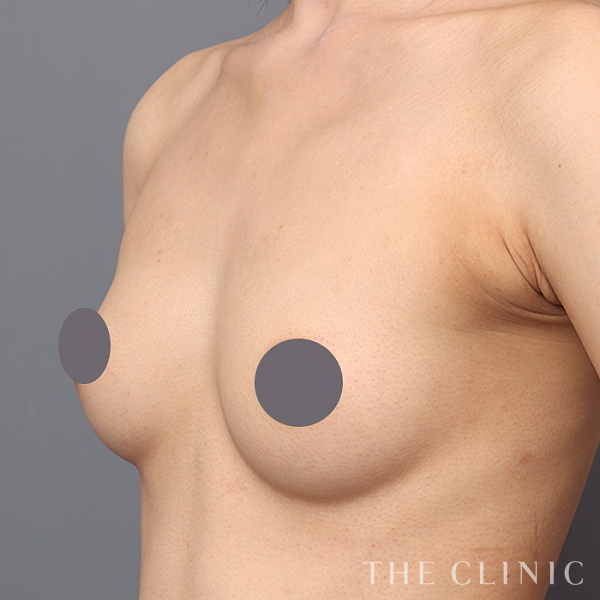 ボリュームアップのコンデンスリッチ豊胸（25歳女性）の術前写真