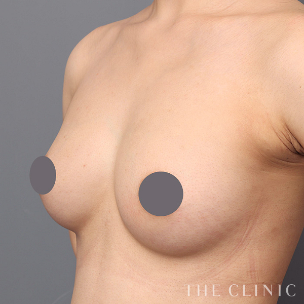 ボリュームアップのコンデンスリッチ豊胸（25歳女性）の術後写真