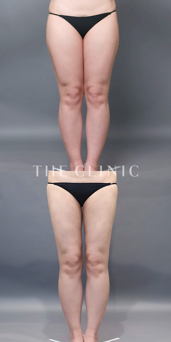 太もものベイザー脂肪吸引（29歳女性）の術前・術後写真