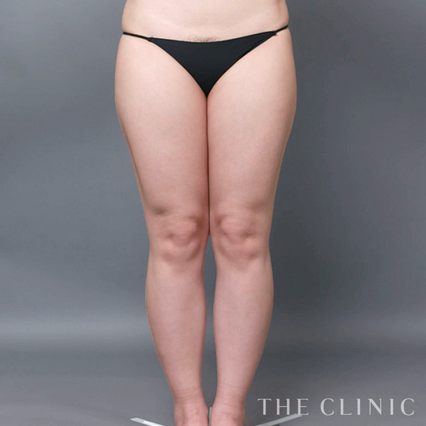 太もものベイザー脂肪吸引（29歳女性）の術前写真