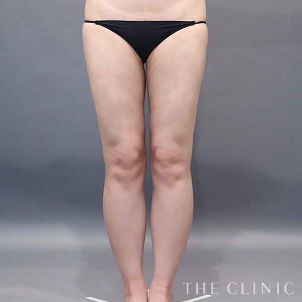 太もものベイザー脂肪吸引（29歳女性）の術後写真