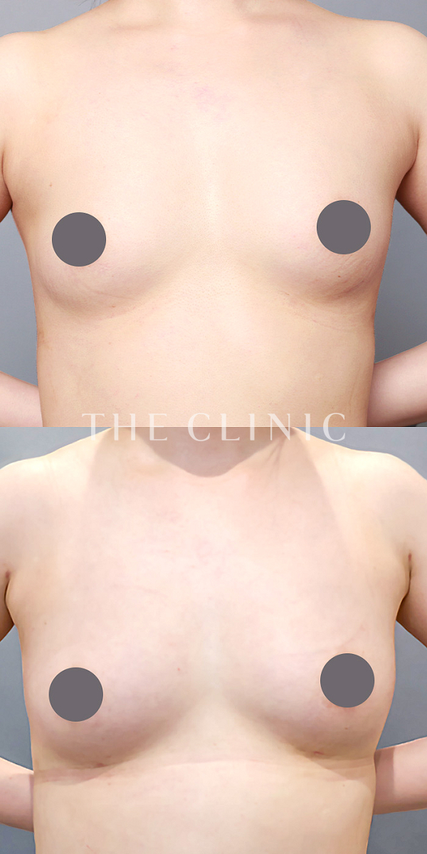 ボリュームアップのコンデンスリッチ豊胸（25歳女性）の術前・術後写真