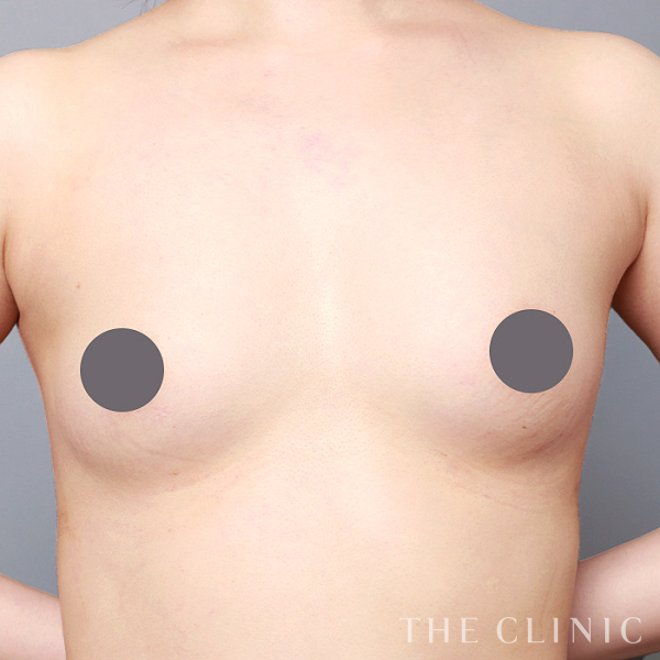 ボリュームアップのコンデンスリッチ豊胸（25歳女性）の術前写真