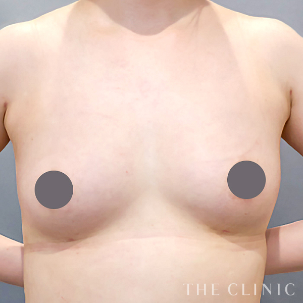 ボリュームアップのコンデンスリッチ豊胸（25歳女性）の術後写真