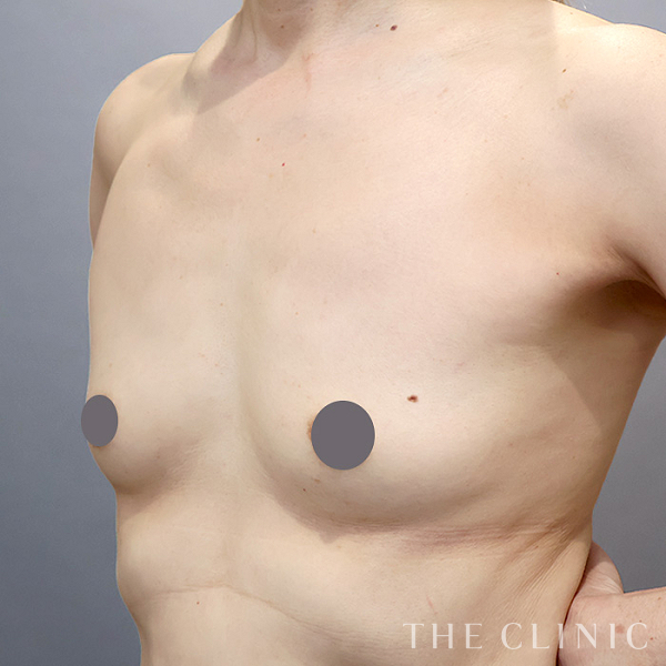 ボリュームアップの上向きバスト豊胸（52歳女性）の術前写真