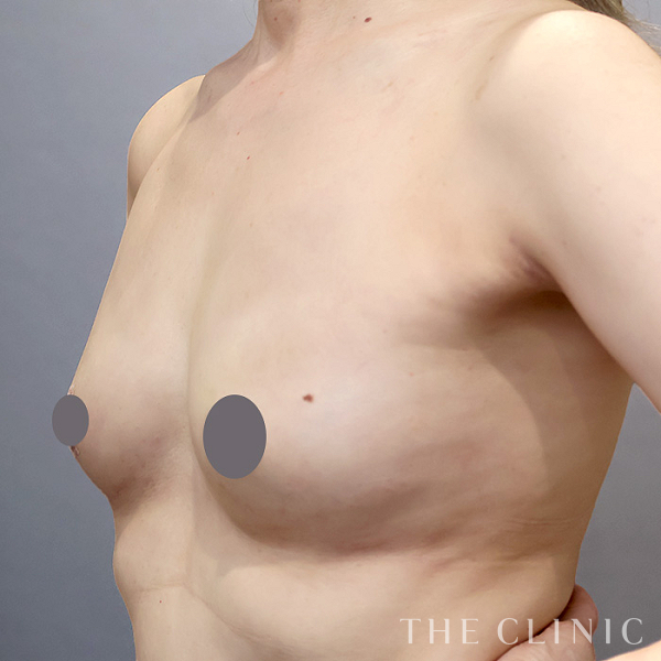 ボリュームアップの上向きバスト豊胸（52歳女性）の術後写真