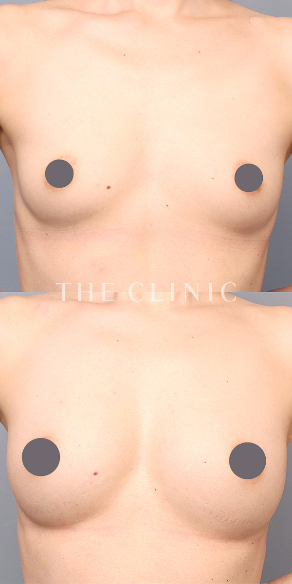 ボリュームアップのコンデンスリッチ豊胸（39歳女性）の術前・術後写真