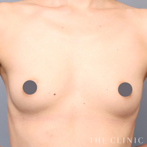 ボリュームアップのコンデンスリッチ豊胸（39歳女性）の術前写真