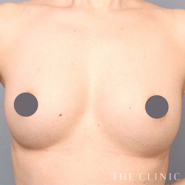 ボリュームアップのコンデンスリッチ豊胸（39歳女性）の術後写真