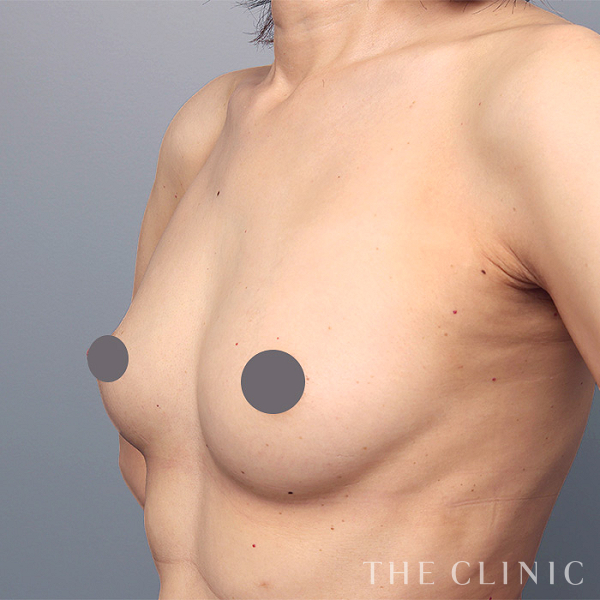 ボリュームアップのコンデンスリッチ豊胸（45歳女性）の術前写真