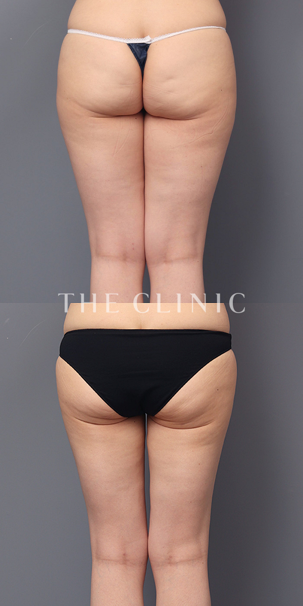 太もものベイザー脂肪吸引（45歳女性）の術前・術後写真