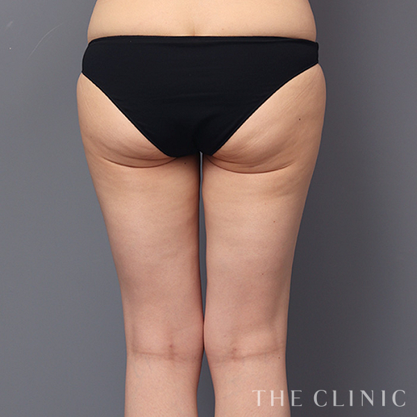 太もものベイザー脂肪吸引（45歳女性）の術後写真