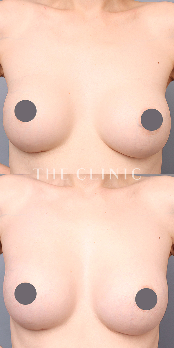 ボリュームアップのコンデンスリッチ豊胸（37歳女性）の術前・術後写真