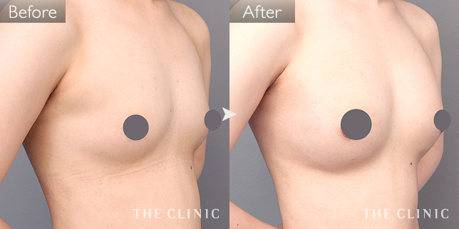 豊胸・胸の整形 ボリュームアップ 症例写真