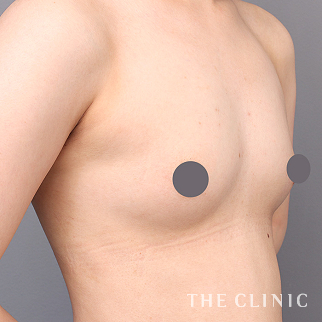 【THE CLINIC 症例画像】No.1494_1_ボリュームアップ_コンデンスビブラ豊胸(執刀医:)