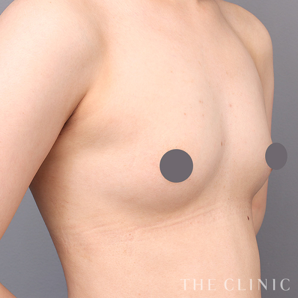 ボリュームアップのコンデンスビブラ豊胸（21歳女性）の術前写真