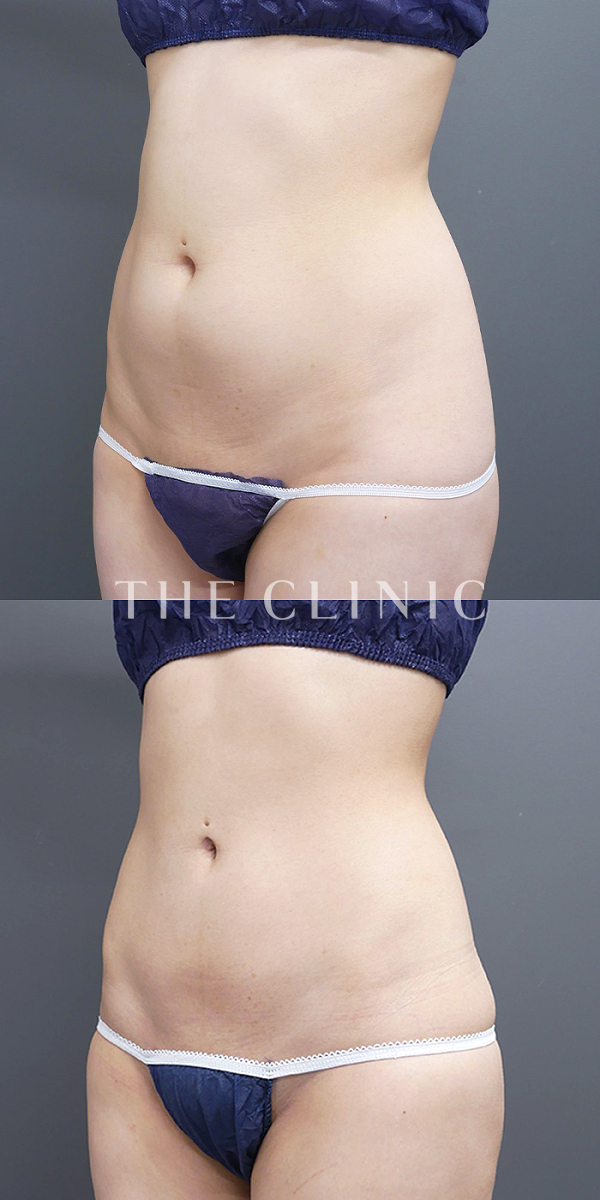 腹部のベイザー脂肪吸引（26歳女性）の術前・術後写真