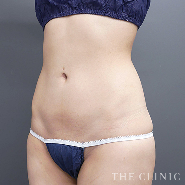 腹部のベイザー脂肪吸引（26歳女性）の術後写真
