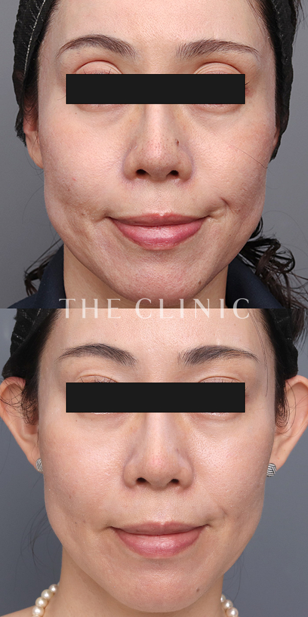 目の上のくぼみのマイクロCRF注入(顔の脂肪注入)（43歳女性）の術前・術後写真