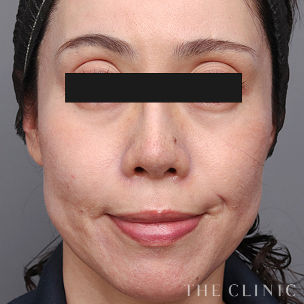 目の上のくぼみのマイクロCRF注入(顔の脂肪注入)（43歳女性）の術前写真