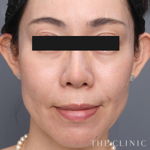 目の上のくぼみのマイクロCRF注入(顔の脂肪注入)（43歳女性）の術後写真