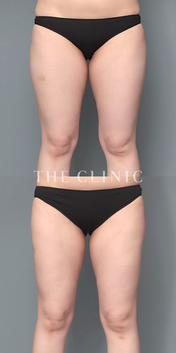 太もものベイザー脂肪吸引（34歳女性）の術前・術後写真