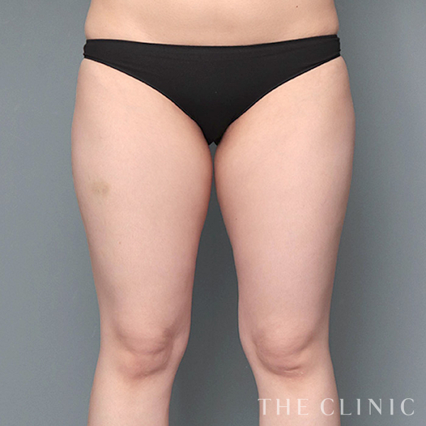 太もものベイザー脂肪吸引（34歳女性）の術前写真