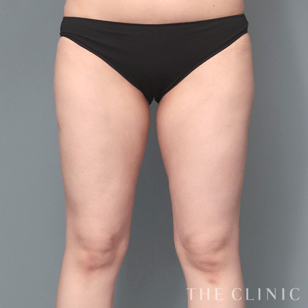 太もものベイザー脂肪吸引（34歳女性）の術後写真