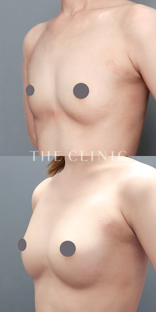 ボリュームアップのコンデンスリッチ豊胸（26歳女性）の術前・術後写真