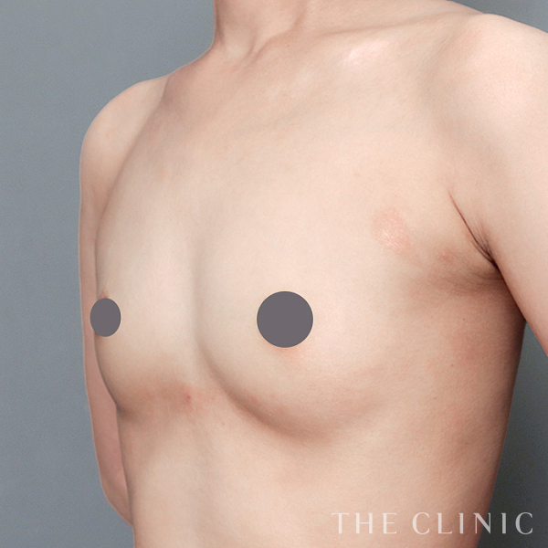 ボリュームアップのコンデンスリッチ豊胸（26歳女性）の術前写真