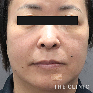 【THE CLINIC 症例画像】No.1500_1_目の下のクマ_コンデンスリッチフェイス(顔の脂肪注入)(執刀医:)