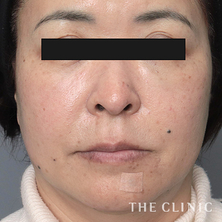 【THE CLINIC 症例画像】No.1500_2_目の下のクマ_コンデンスリッチフェイス(顔の脂肪注入)(執刀医：)