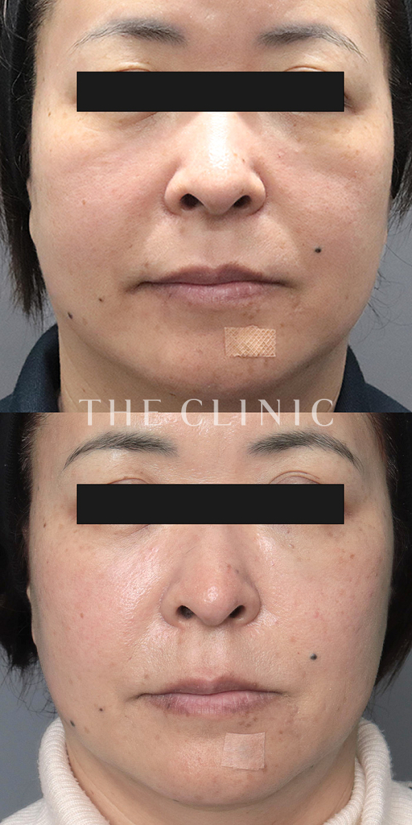 目の下のクマ・ゴルゴライン・法令線のコンデンスリッチフェイス(顔の脂肪注入)（53歳女性）の術前・術後写真