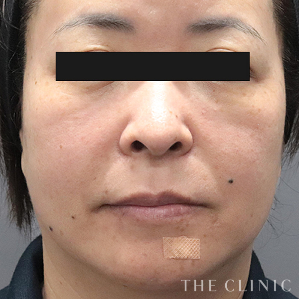 目の下のクマ・ゴルゴライン・法令線のコンデンスリッチフェイス(顔の脂肪注入)（53歳女性）の術前写真