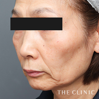 【THE CLINIC 症例画像】No.1502_1_こけた頬_SRF注入(顔の脂肪注入)(執刀医:安部 光洋)