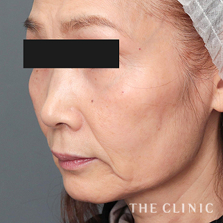 【THE CLINIC 症例画像】No.1502_2_こけた頬_SRF注入(顔の脂肪注入)(執刀医:安部 光洋)