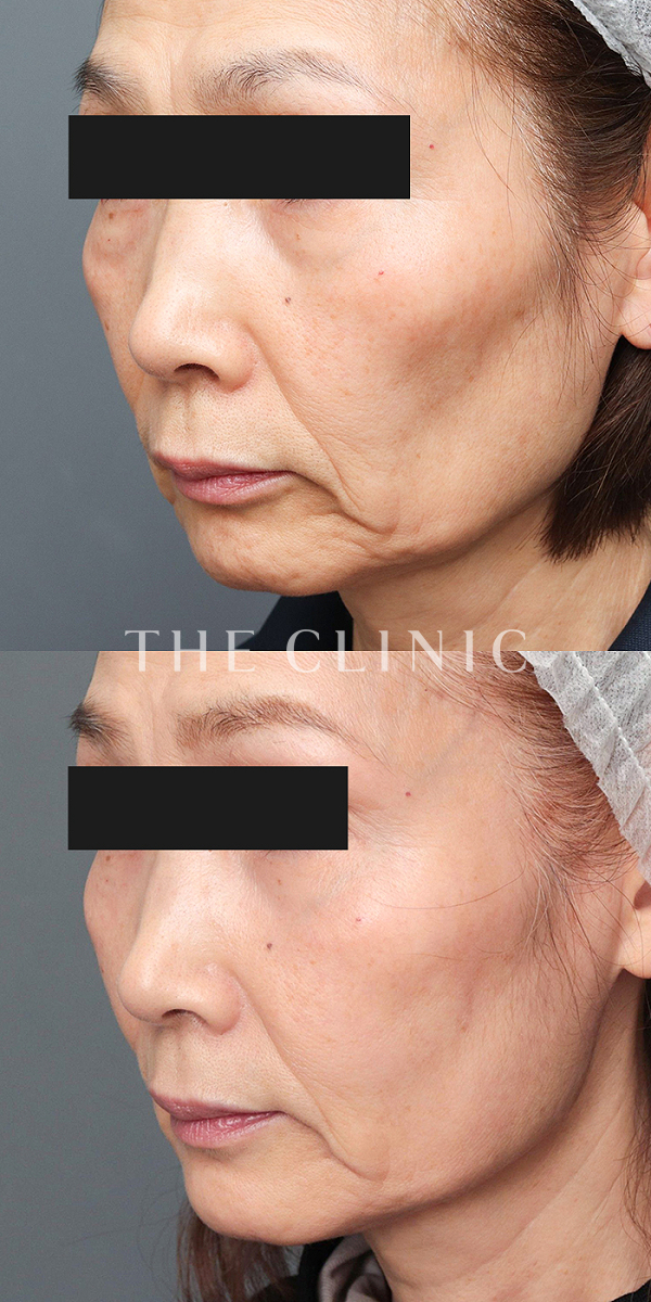 こけた頬のSRF注入(顔の脂肪注入)（69歳女性）の術前・術後写真