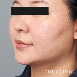 【THE CLINIC 症例画像】No.1503_2_頰/顎_360脂肪吸引®(執刀医:大橋 昌敬)