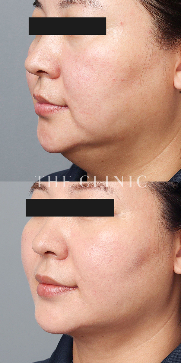 頰／顎のベイザー脂肪吸引（44歳女性）の術前・術後写真