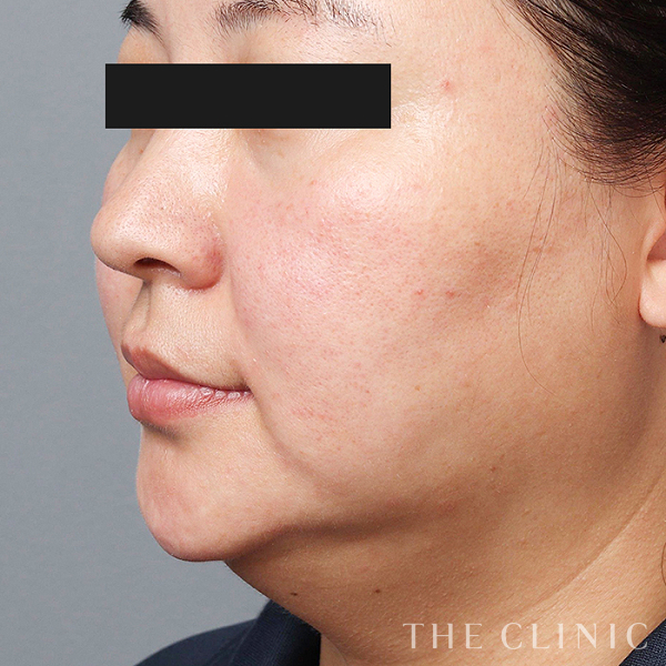 頰／顎のベイザー脂肪吸引（44歳女性）の術前写真