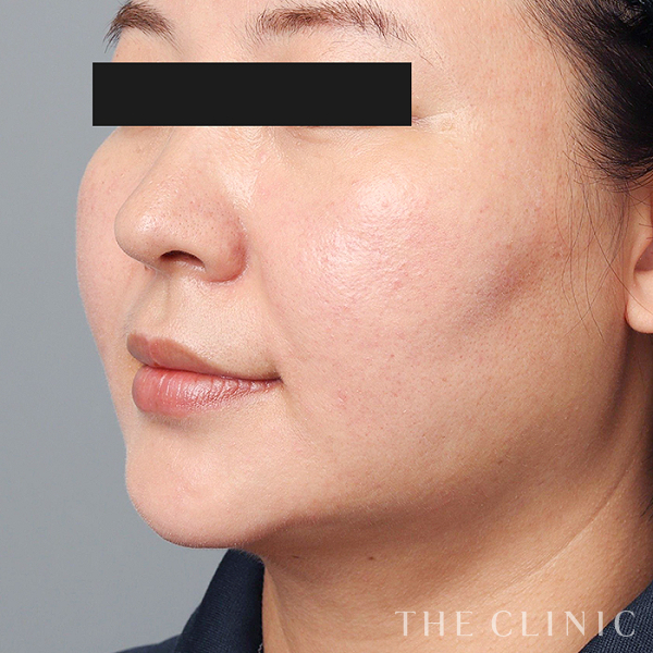 頰／顎のベイザー脂肪吸引（44歳女性）の術後写真