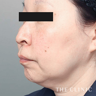【THE CLINIC 症例画像】No.1504_1_頰/顎_ベイザー脂肪吸引(執刀医:大橋 昌敬)