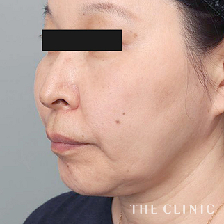 【THE CLINIC 症例画像】No.1504_2_頰/顎_ベイザー脂肪吸引(執刀医:大橋 昌敬)